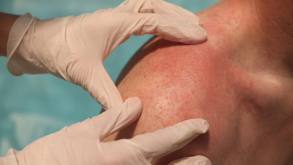 Choroby skóry, a słońce – kiedy nie warto się opalać?